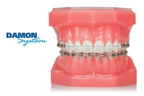 damon braces ortho services 3 Damon Braces
