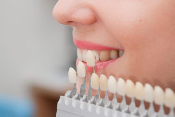 hollywood smile veneers Hollywood Smile