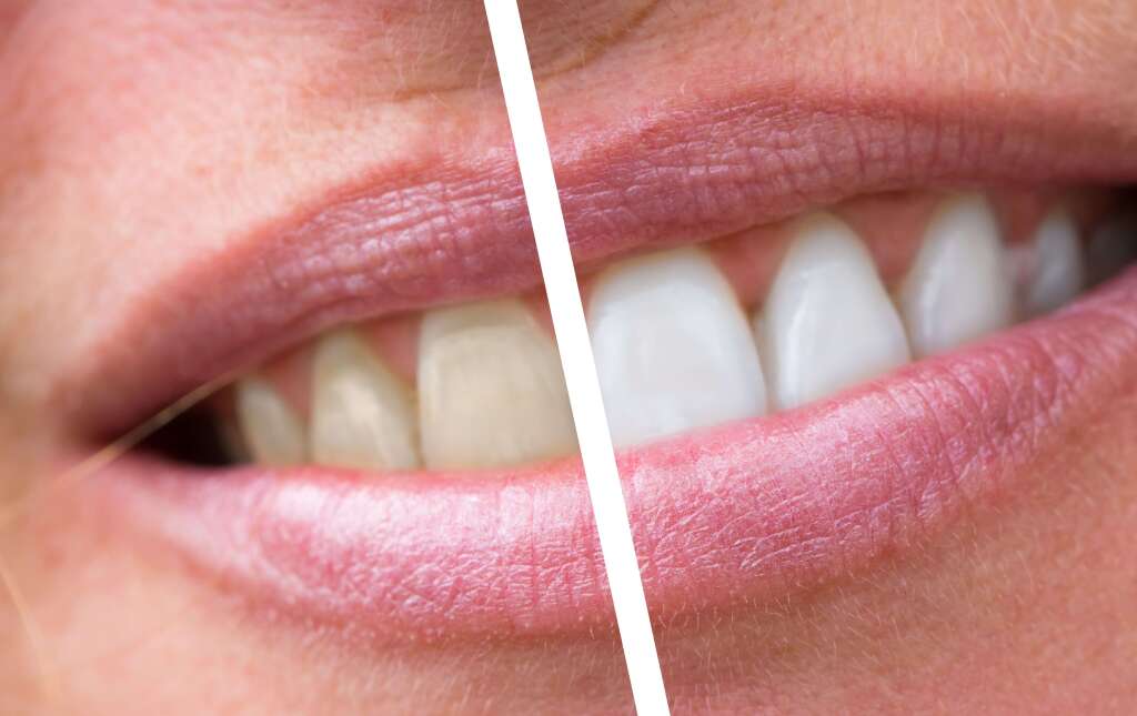 shutterstock 493123822 Teeth Whitening
