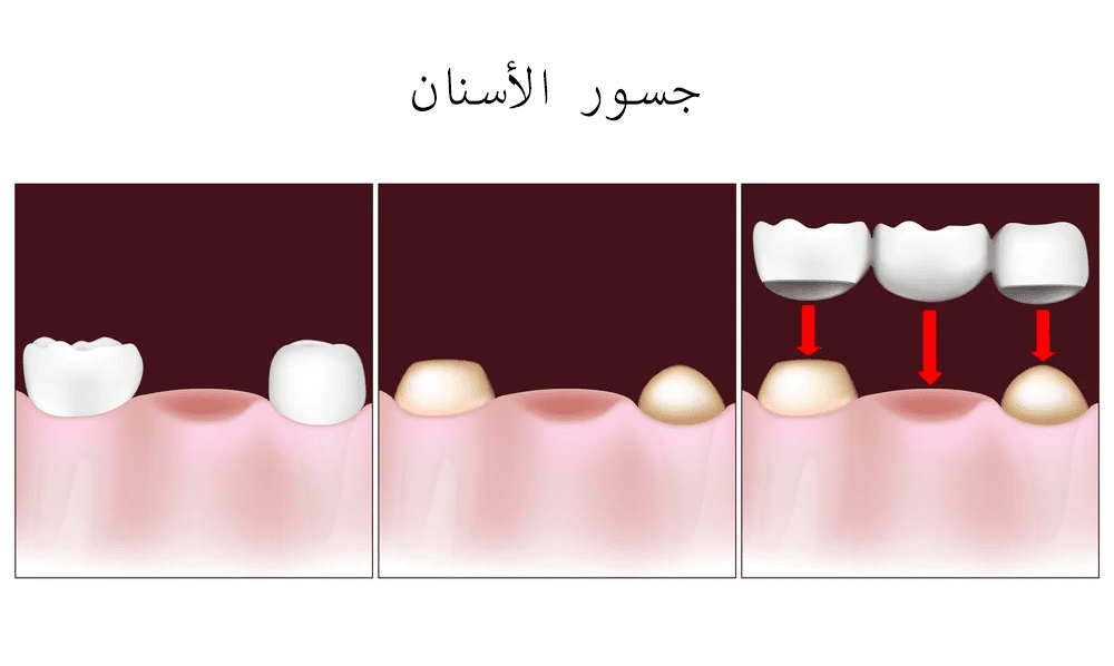 جسور الأسنان