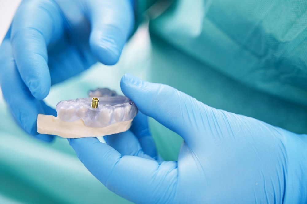Procedure for getting Dental Implants dental Implant
