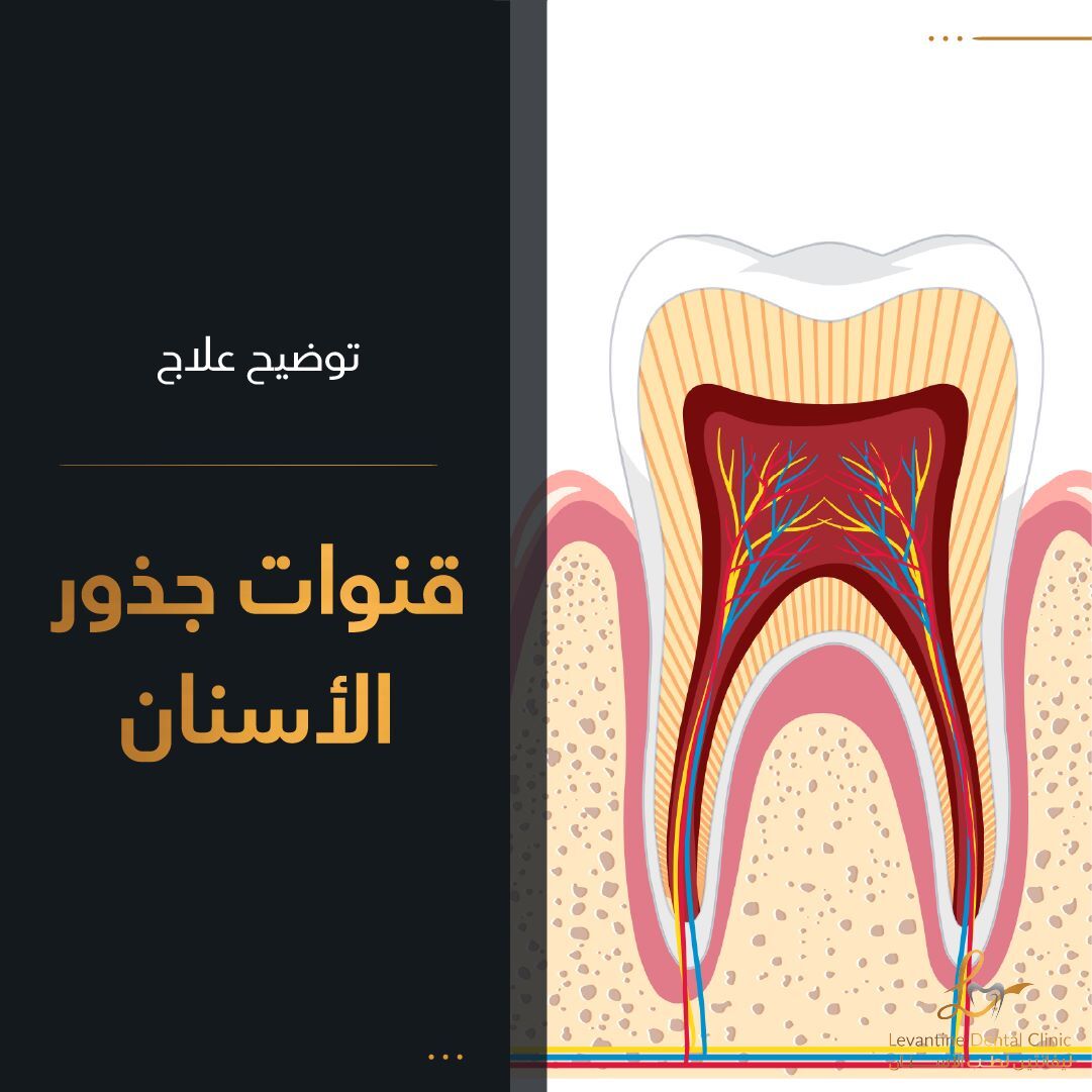 توضيح علاج قناة الجذر