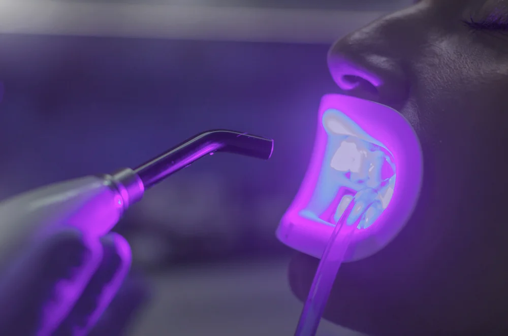 Best Gum Bleaching Results in Dubai Gum Bleaching