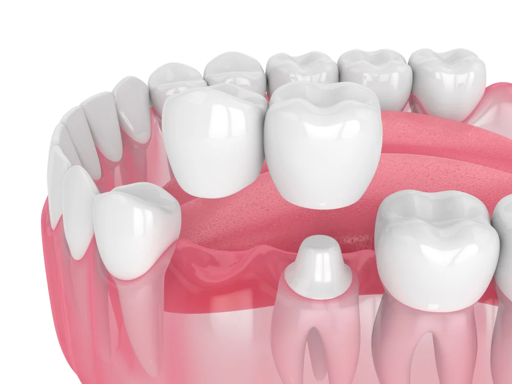 Cantilever Bridges Dental Bridges