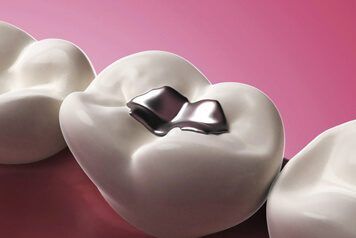 amalgam gum Gum Bleaching