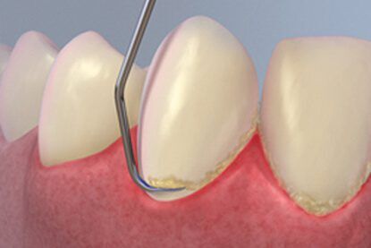 scaling preventive preventive dentistry