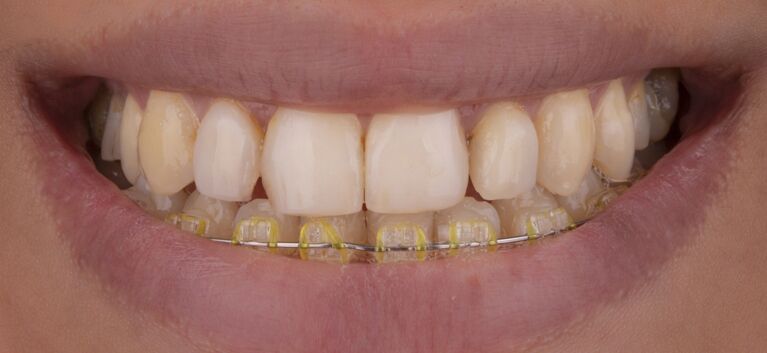 Hollywood smile - makeover -before