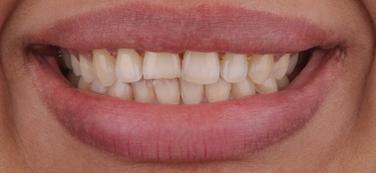 Hollywood smile - makeover -before