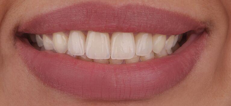 Hollywood smile - makeover -after