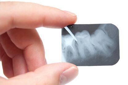 الأشعة السينية لمنطقة العظام