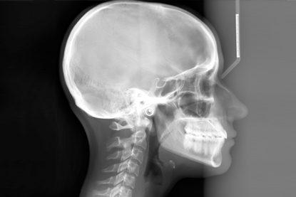 CEPHALOMETRIC x-ray