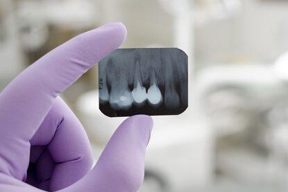 الاشعة النطاقية