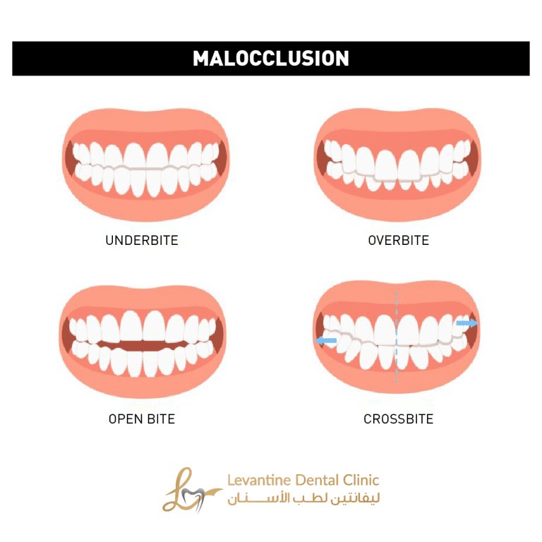 how braces can address jaw alignment issues like overbites, underbites, and crossbites. Get expert insights on benefits, types, and treatment options.
