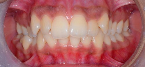 11-before-ortho