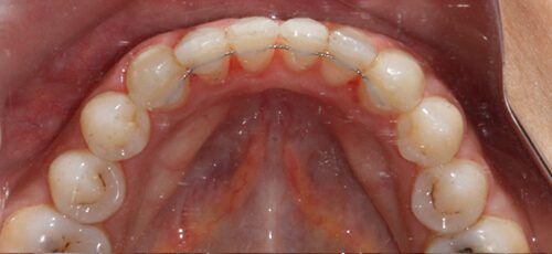 13after