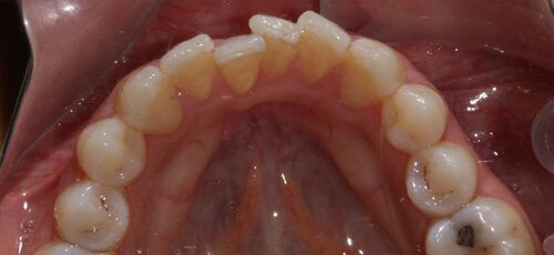 13before
