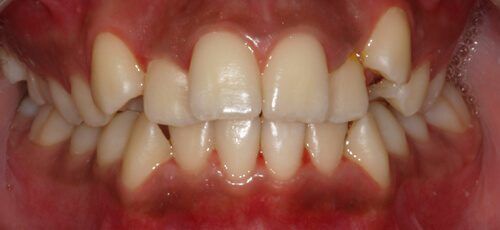 6before