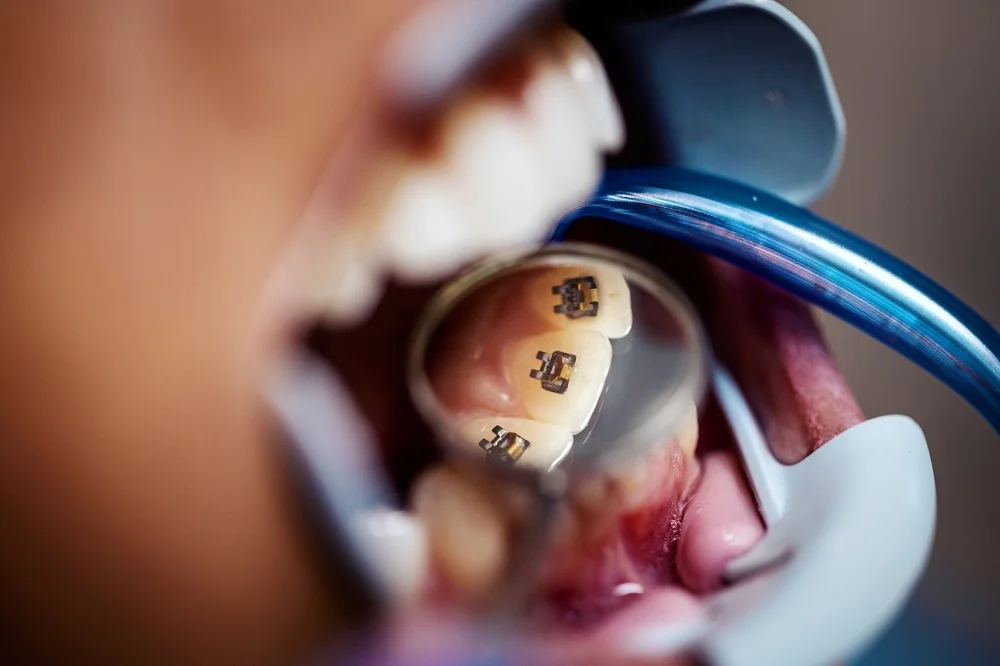 Lingual Braces 5 Advantages of Lingual Braces Lingual Braces