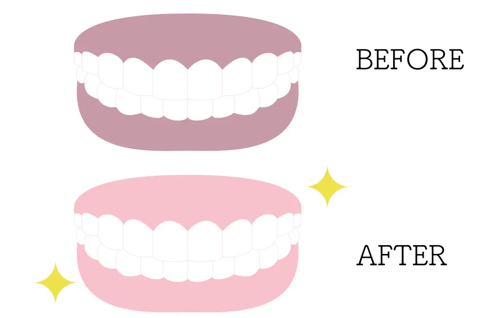 Gum Bleaching 2 gum-bleaching