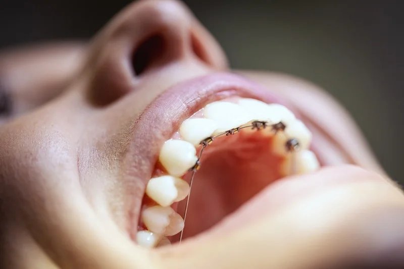 Lingual Braces 3 Lingual Braces 1 Lingual Braces