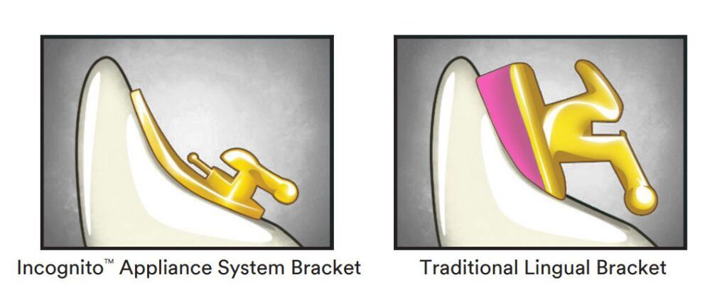 Lingual Braces 4 lingual braces incognito Lingual Braces