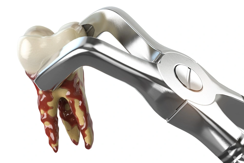 Oral and Maxillofacial Surgery 2 Third Molar Oral and Maxillofacial Surgery