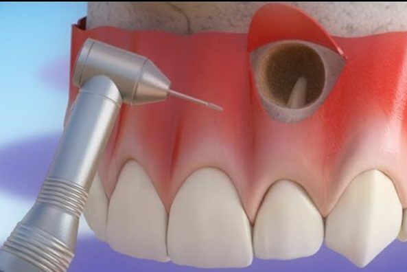 Oral and Maxillofacial Surgery 5 apicoecotomy oral Oral and Maxillofacial Surgery