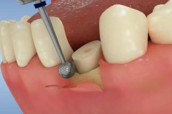 Oral and Maxillofacial Surgery 3 crown length oral Oral and Maxillofacial Surgery