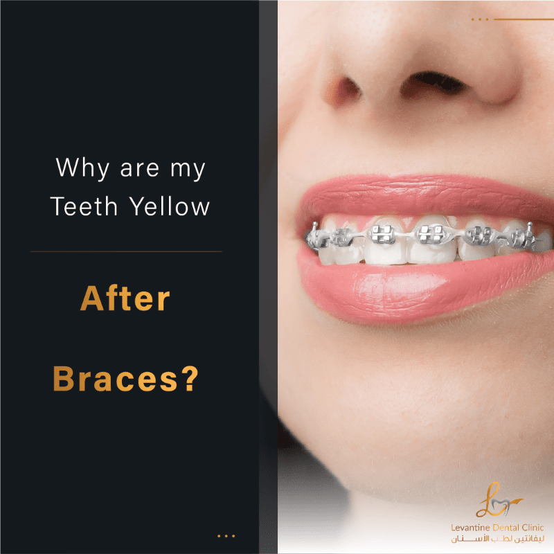 Why are my Teeth Yellow after Braces