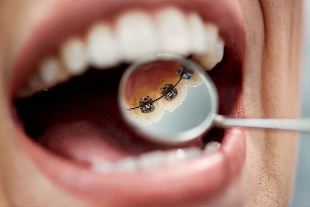Lingual Braces 1 Lingual Braces at Levantine Dental Clinic the best dental clinic in dubai