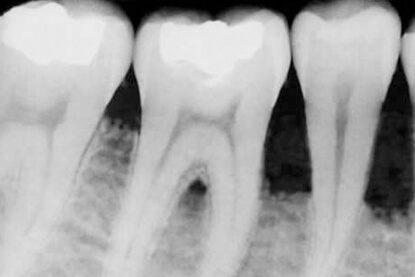 dental x-ray 3 الأشعة السينية لتحديد تجاويف الأسنان