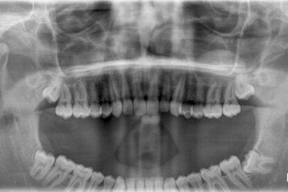 dental x-ray 5 الأشعة السينية لصحة الفم