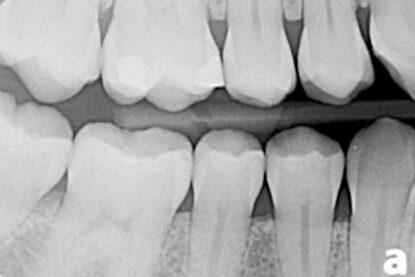 dental x-ray 8 اشعة العض