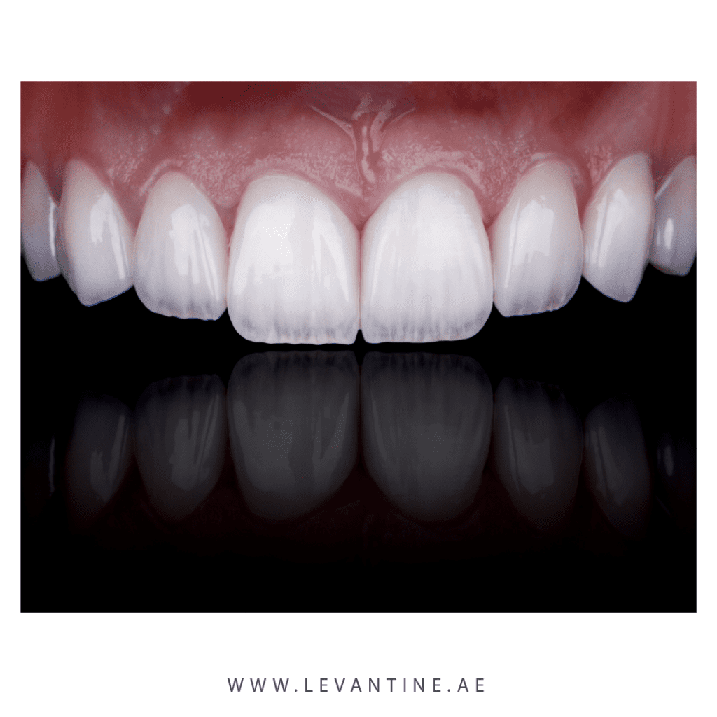 Dental Veneers 2 composite veneers Dental Veneers
