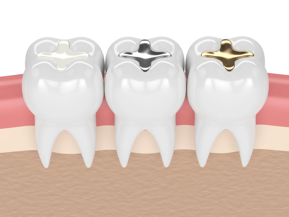 اختلاف انواع حشوات الأسنان diffrance of Dental Fillings in Dubai What is Porcelain Fillings? Every thing you need to know