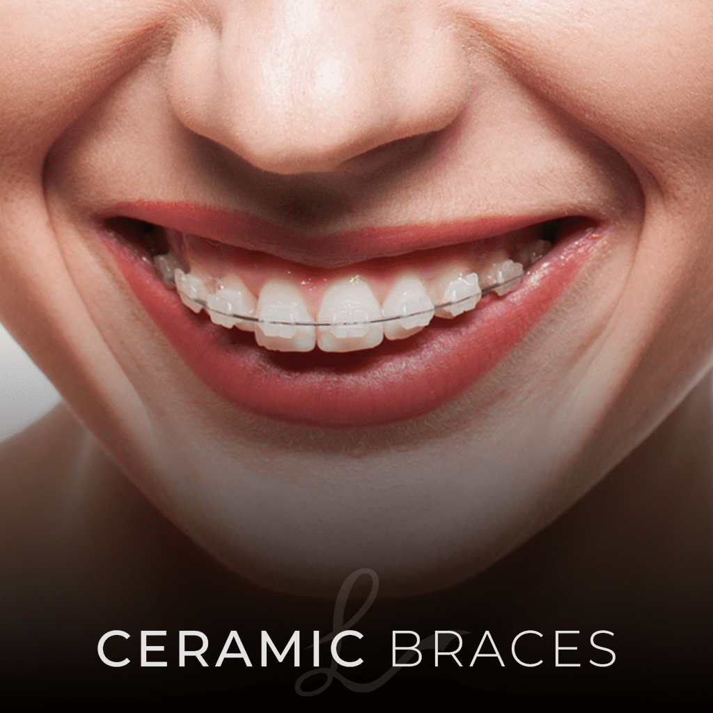 The Different Types of Orthodontic BRACES: Which Type is Right for You? 2 CERAMIC BRACES The Different Types of Orthodontic BRACES: Which Type is Right for You?