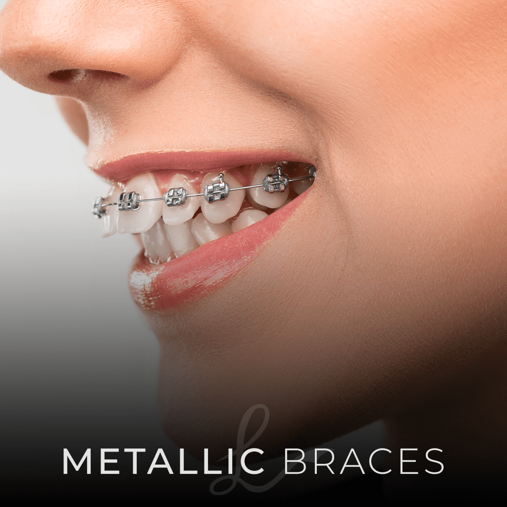 The Different Types of Orthodontic BRACES: Which Type is Right for You? 1 metallic Braces The Different Types of Orthodontic BRACES: Which Type is Right for You?