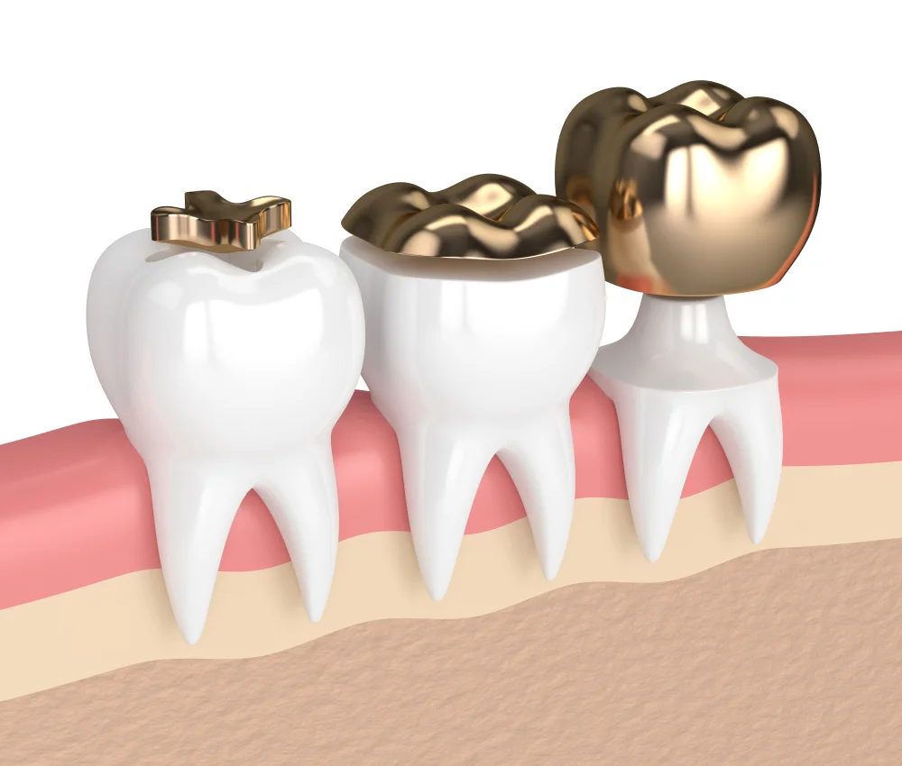 Gold-tooth-Fillings
