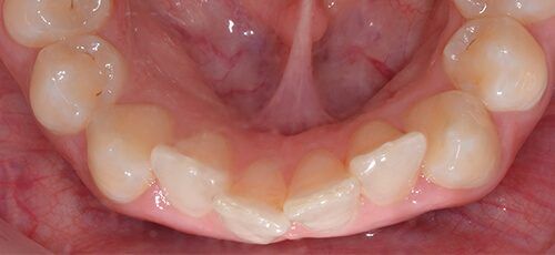 قبل التقويم الاسنان