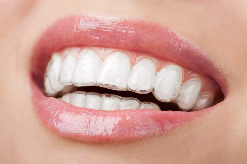 Invisalign 2 1 Orthodontics Treatment