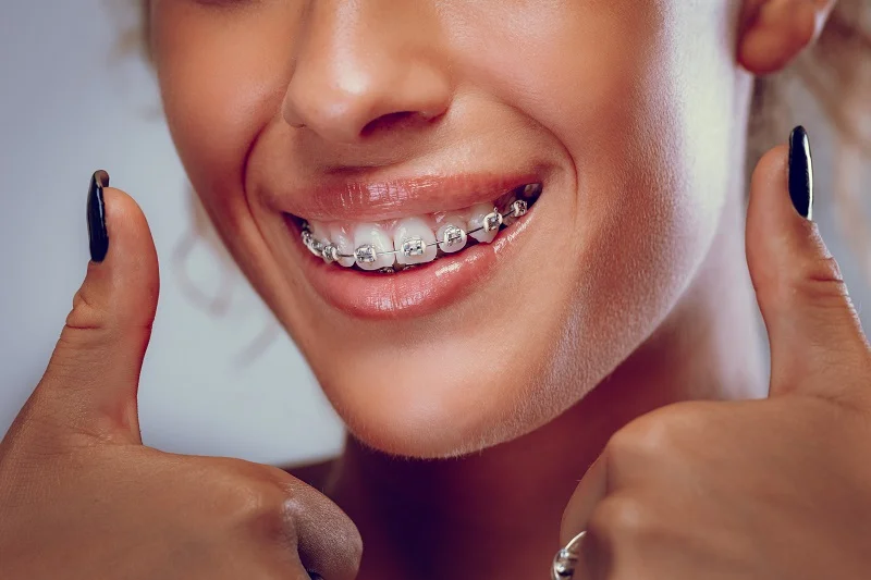 dental braces orthodontist in dubai