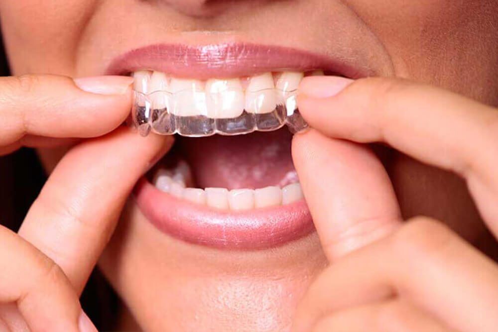 eon Orthodontics Treatment