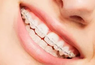 Damon-smile-braces-levantine-dental-clinic