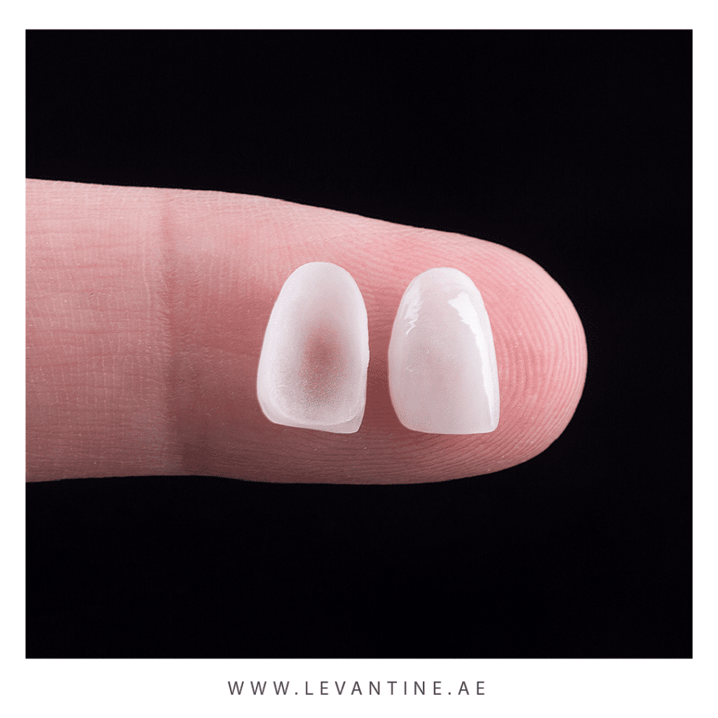 porcilen veneers Dental Veneers