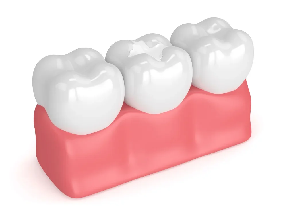Difference-between-Composite-and-Porcelain-denta-Fillings