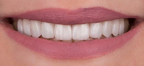 شكل الاسنان بعد تركيب الفينير