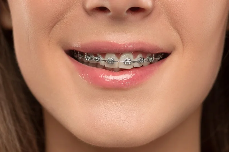 Best Ceramic and Metal Braces in Dubai Metal & Crystal Braces