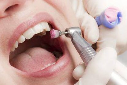 polishing preventive preventive dentistry