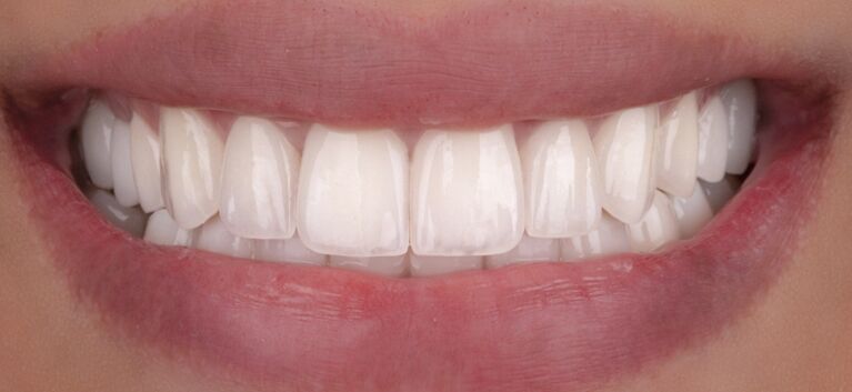 Hollywood smile - makeover -after