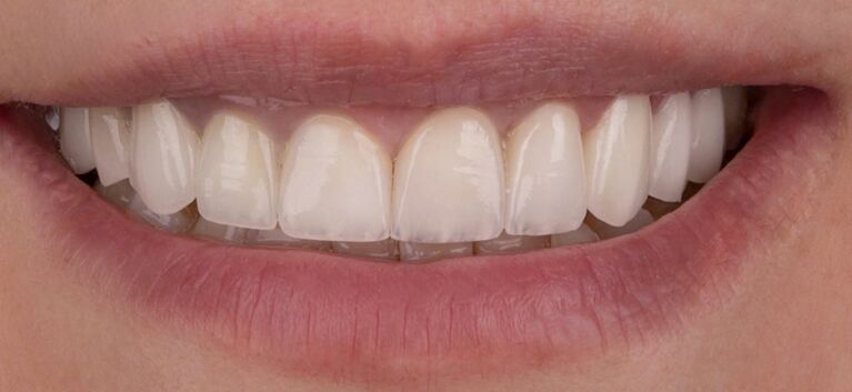 Hollywood smile - makeover -after